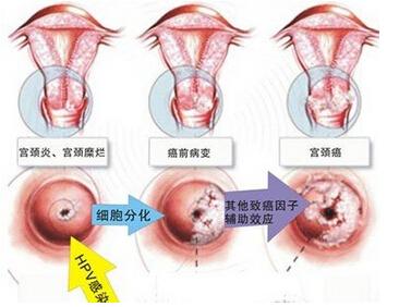 HPV感染与复查的重要性，为何三个月后复查是关键？