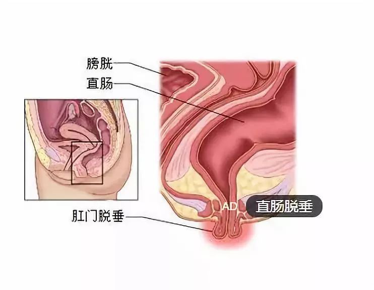 孕7个月肛门坠胀，原因、影响与管理