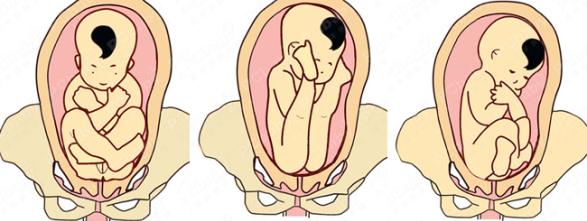 四个月胎位不正怎么办，了解、应对与预防